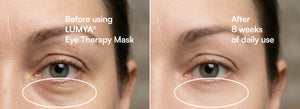 LUMYA® Eye Therapy Mask – Intelligent Heat, Cooling & Targeted Massage for Eye Recovery